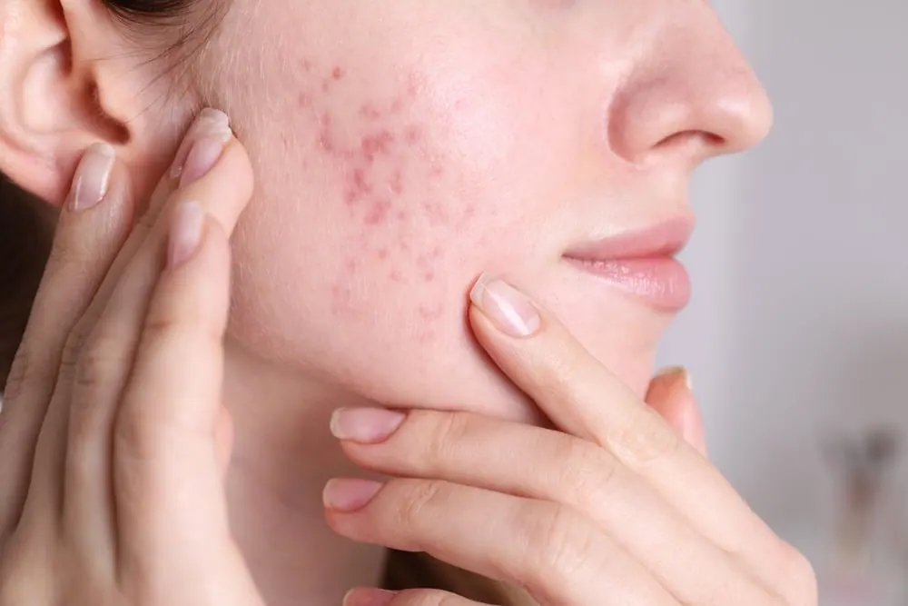 Acne & Acne Scarring